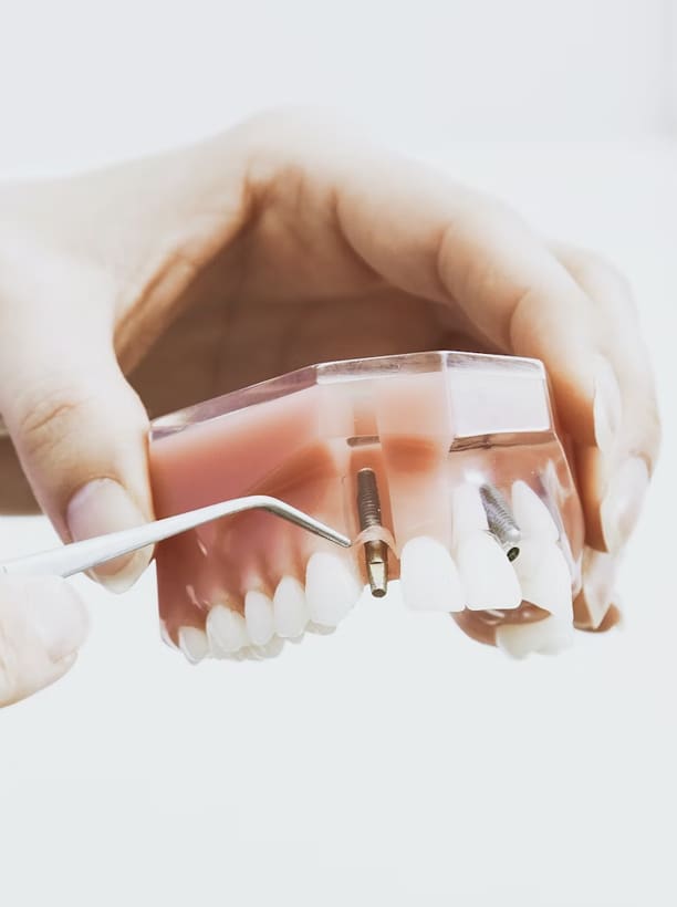 Dental Sealants